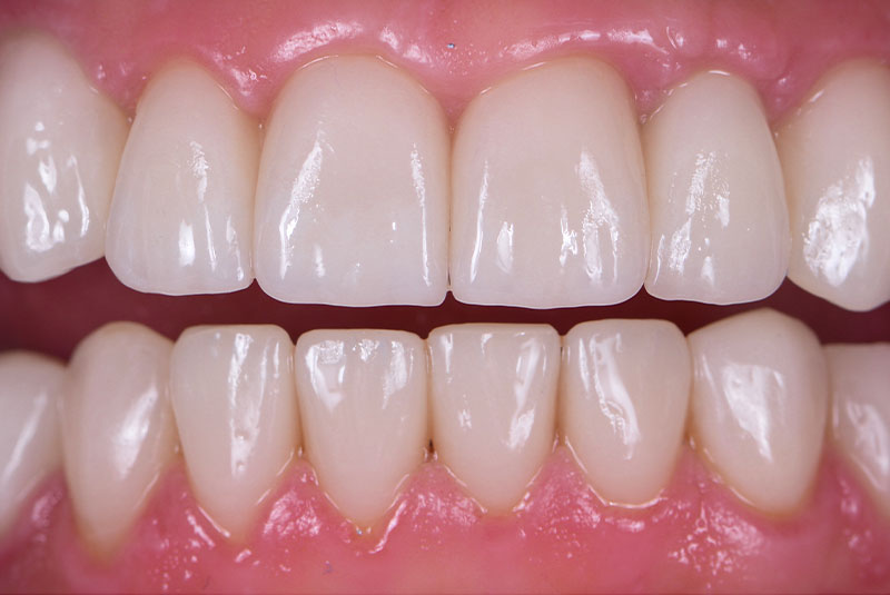 Close up photo of before and after image of a dental procedure