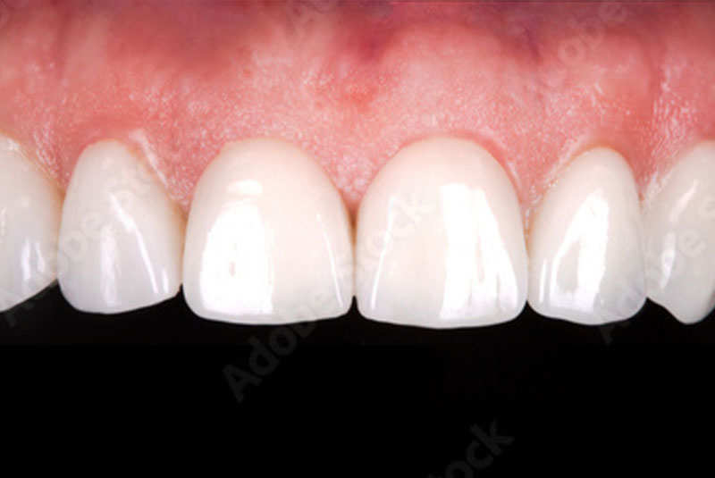 Close up photo of before and after image of a dental procedure