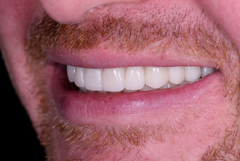 Close up photo of before and after image of a dental procedure