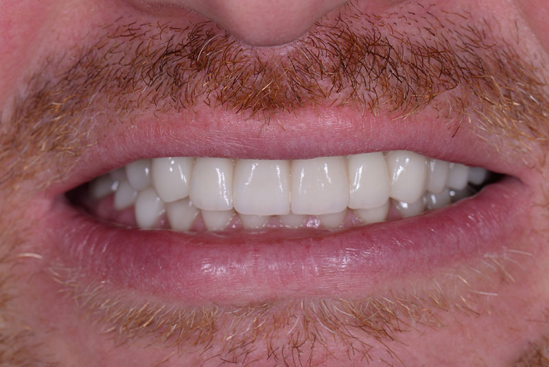 Close up photo of before and after image of a dental procedure
