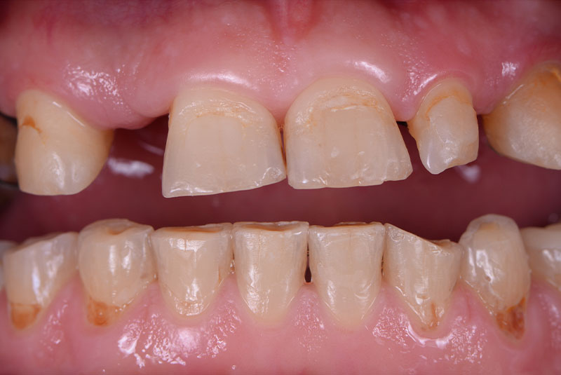 Close up photo of before and after image of a dental procedure