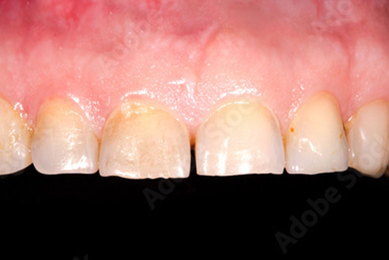 Close up photo of before and after image of a dental procedure