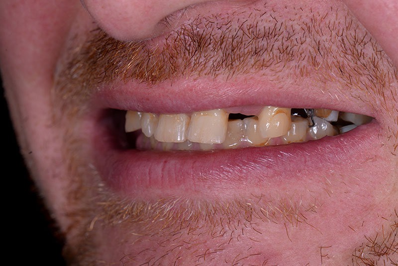 Close up photo of before and after image of a dental procedure