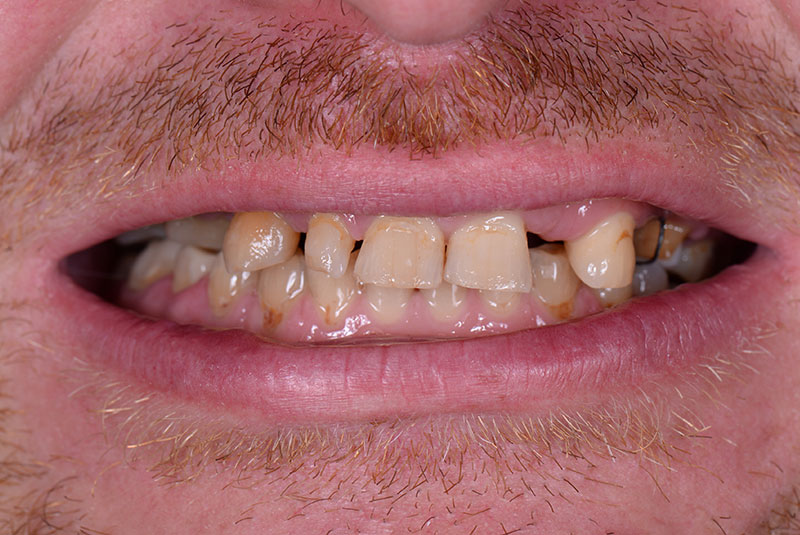 Close up photo of before and after image of a dental procedure