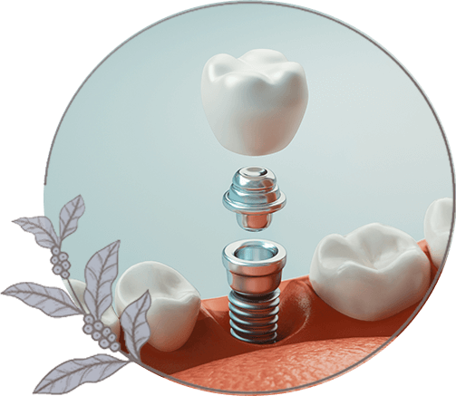 close up of single tooth dental implant