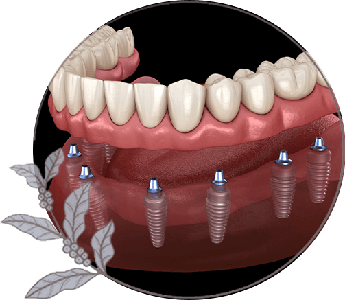 close up of full arch dental implant model