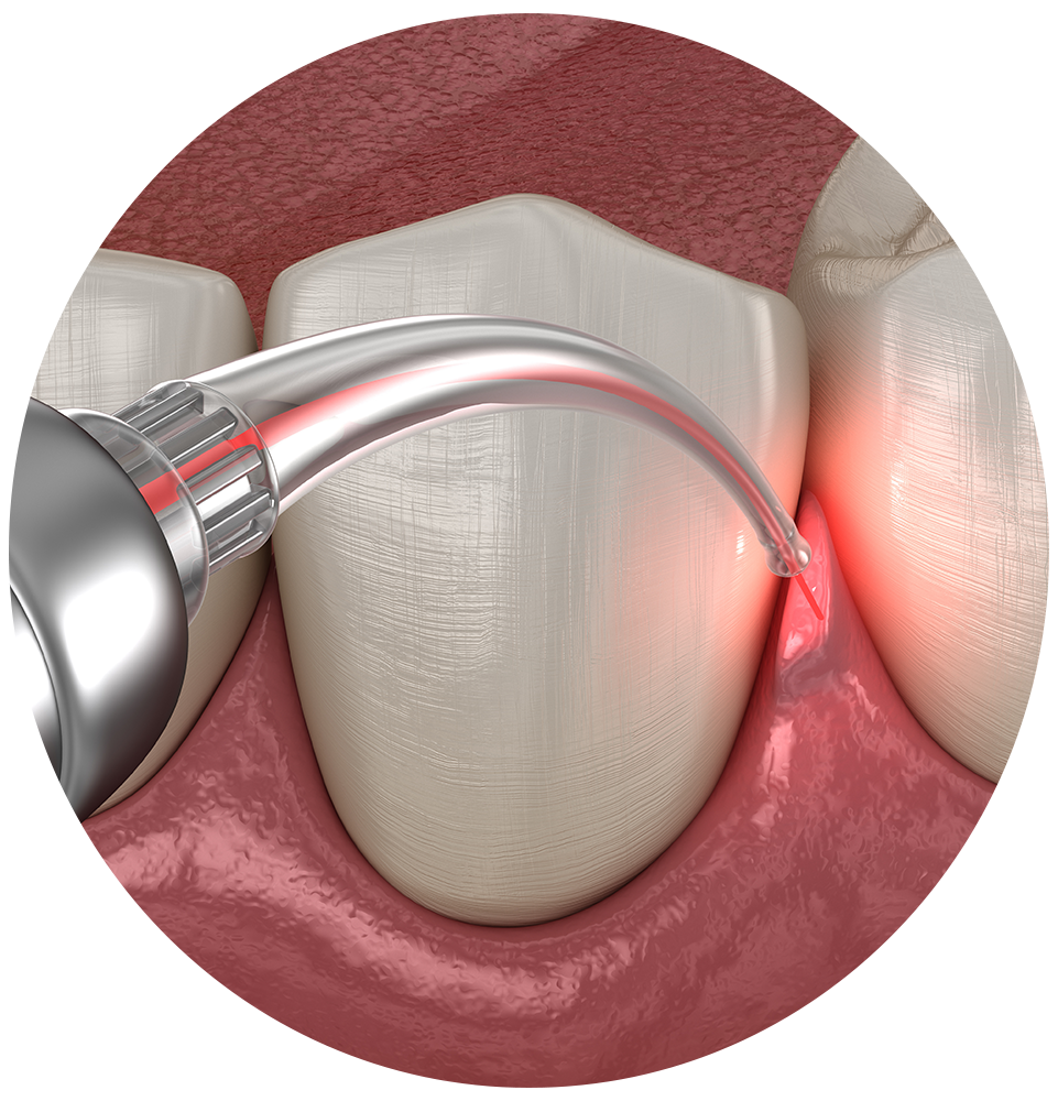 close up of laser periodontics treatment